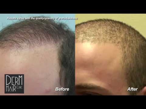 FUE Hair transplant : Buzz cut after body hair transplant and strip scar repair.