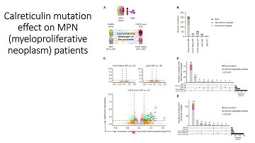 Cancer : Effect of calreticulin mutation on MPN (myeloproliferative neoplasm) patients #Code: 214
