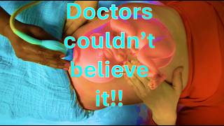 Surgery for breech. Until mom helped this ECV with her hands for a natural birth.