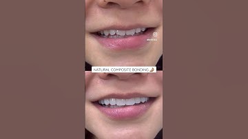 Natural composite bonding to repair chipped/worn edges. 🔥 #ruhdental