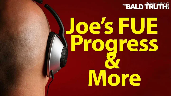 The Bald Truth Friday July 26th, 2019 Hair loss, Hair Transplants, FUE