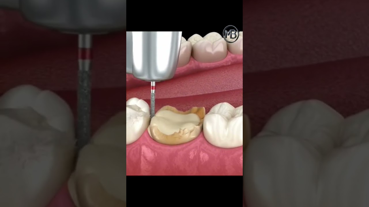 Dental Caries Removal Dental Clinic