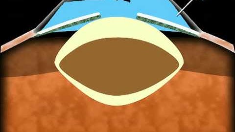 Animation - Healon for  rhexis in a hypermature cataract