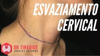 Inchado direito lado linfonodo occipital do