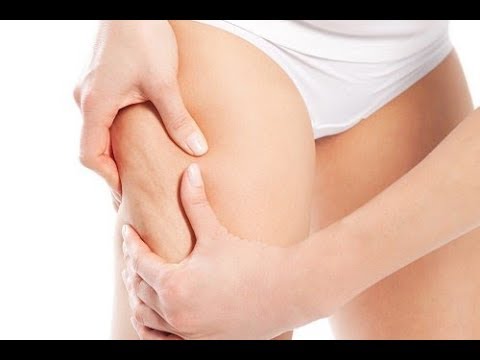 Infusies om cellulite te bestrijden