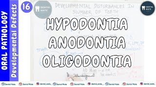 Hypodontia | Anodontia | Oligodontia | Developmental disturbances of teeth | Dr Paridhi Agrawal