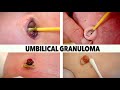 UMBILICAL GRANULOMA COMPILATION | Dr. Paul