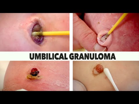 Video: Breast Granuloma - Causes, Diagnosis And Treatment Of Mammary Gland And Navel Granulomas