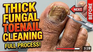 THICK TOENAIL CLEANING