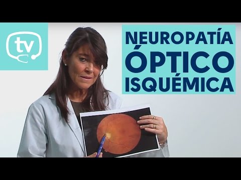 Vídeo: Neuropatía Isquémica Del Nervio óptico