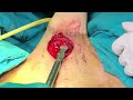 Zsi 475 ftm  application of penile prothesis for reconstructed penis