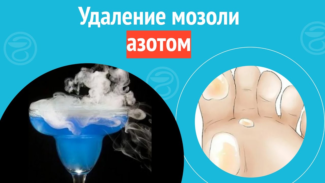 ↪️ Удаление мозоли азотом. Клинический случай №1065 - YouTube