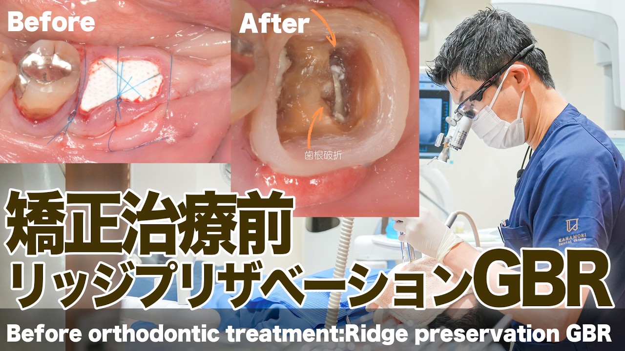 下顎第一大臼歯歯根破折インプラント埋入前処置 リッジプ