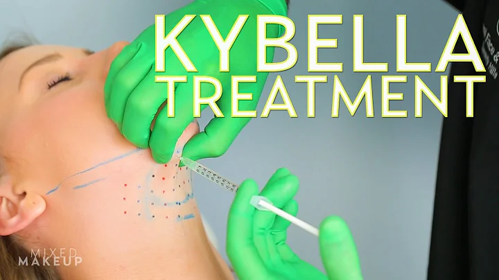 Kybella Treatment to Get Rid of a Double Chin | Th...