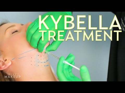Video: Kybella Treatment To Reduce Double Chin