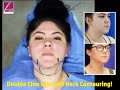 Double Chin Liposuction with Neck Contouring! Wide Awake, Local Anesthesia, In-Office and QUICK!