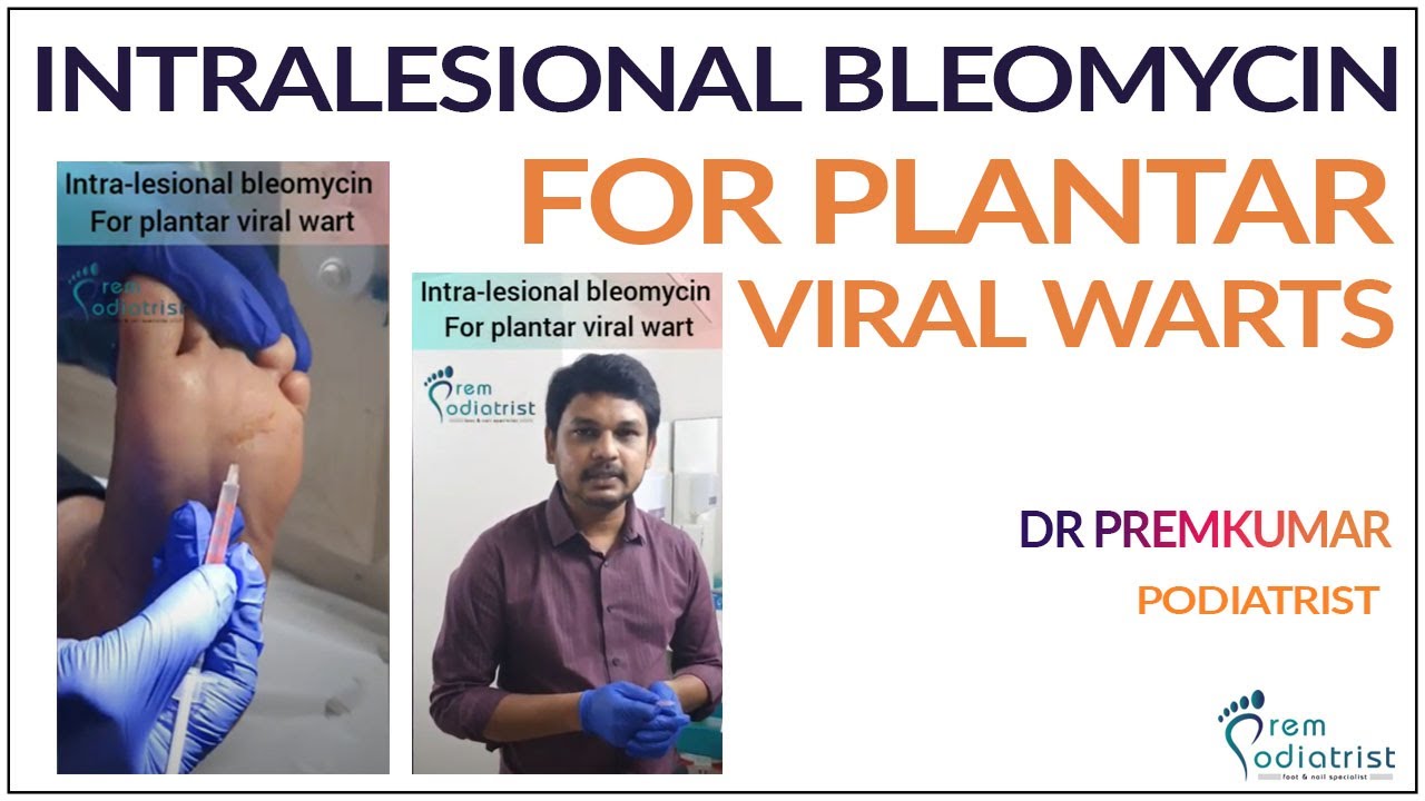 Intralesional bleomycin for plantar viralwarts DrPremkumar 