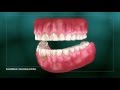 Understanding tooth wear