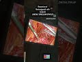 laparoscopic radical excision endometriosis parametrectomy segmental sigmoid rectum resection