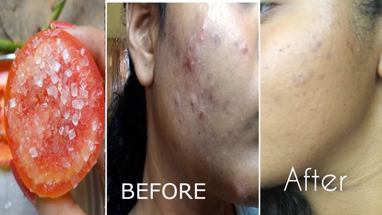 3 MOST EFFECTIVE REMEDIES TO GET RID OF LARGE SKIN PORES - YouTube