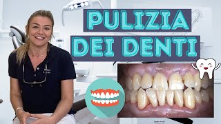 Come funziona la PULIZIA dei DENTI dal dentista?