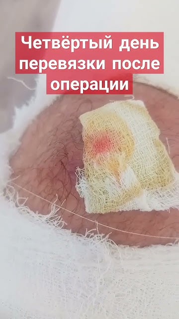 Четвёртый день перевязки после операции - YouTube