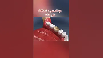 خلع الضرس و المحافظة علي مكانه 