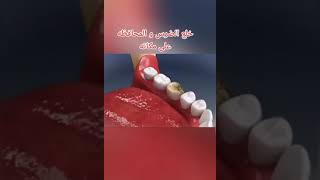 خلع الضرس و المحافظة علي مكانه 💉😷