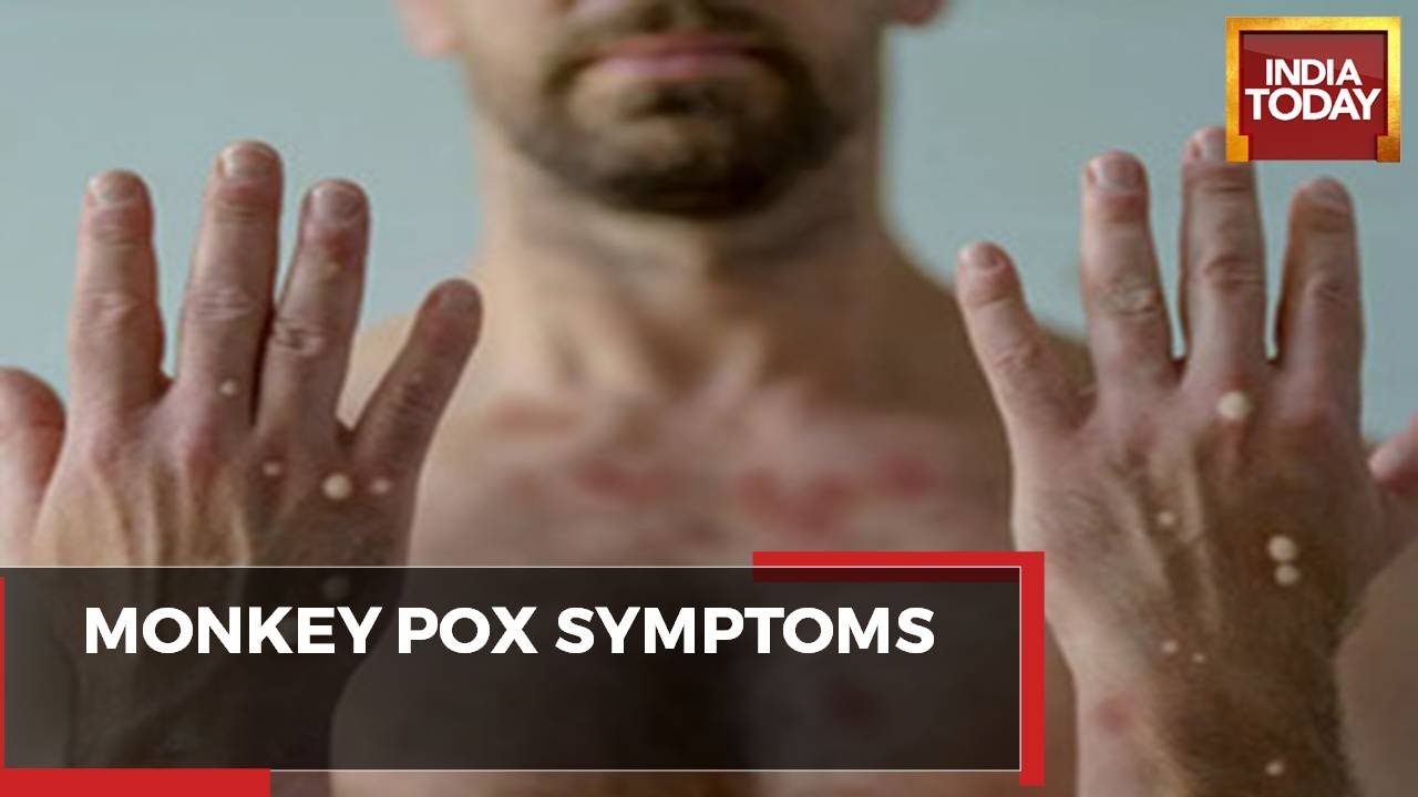 Monkeypox Symptoms: Starts With A Rash, Fever & Respiratory Symptoms