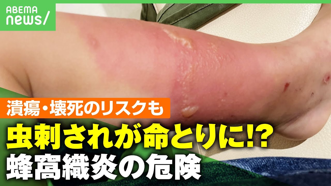 蜂窩 織 炎 こども