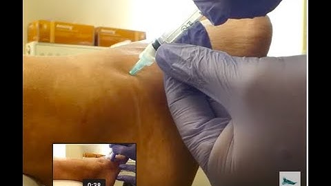 Video - sinus tarsi injection