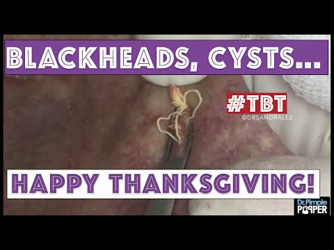Giving Thanks To YOU! Happy Thanksgiving From Dr Pimple Popper