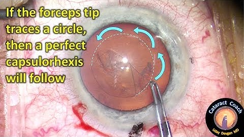 Capsulorhexis made simple for beginning Cataract Surgeons