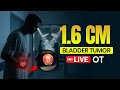 Live OT: 1.6 cm Bladder Tumor | Bladder Tumor Detected Early (1.6 cm) Bladder Tumor Treatment #tumor