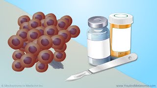 Treating Melanoma