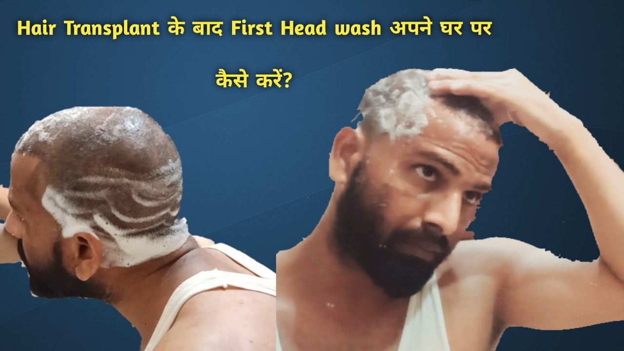 Day 7 | First head wash after Hair Transplant | घर पे कैसे हेड वॉश करे HT के बाद ये गलती कभी ना करे