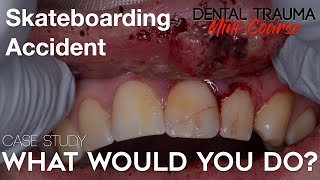 Dental Trauma Mini-Course - Part 15 - Dental Trauma Skateboarding Accident - What would you do?