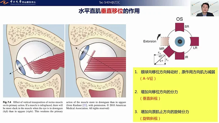 演講：共同性斜視合併的“非共同性”問題——水平直肌肌肉止端移位手術 - 天天要聞