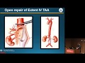 Repair of Thoracic/Thoracoabdominal Aneurysms - Virendra I  Patel, MD, MPH