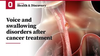 Voice and swallowing disorders after cancer treatment | Ohio State Medical Center