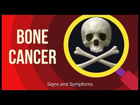 Video: Kā diagnosticēt kaulu vēzi: 15 soļi (ar attēliem)