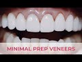 Porcelain veneers smile transformation minimal preparation  dental boutique