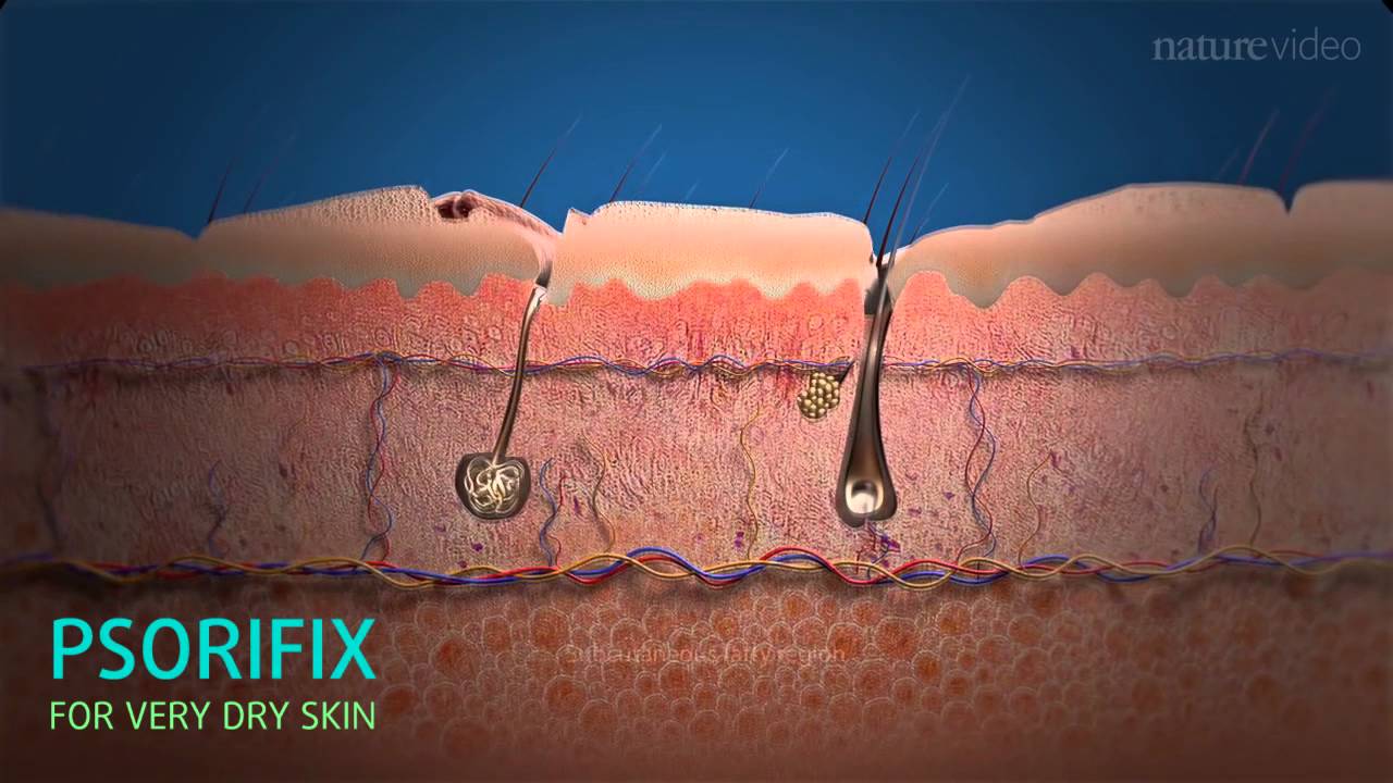 PSORIFIX - Get Rid Of Psoriasis Forever - YouTube