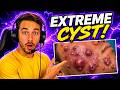 Reacting to Extreme CYST & Pimple Popping Videos (SO SATISFYING)