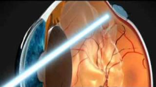 Hepatitis C If I Had - Retinal Detachment