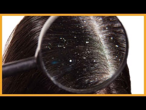 Video: 4 Impacchi Di Capelli All'henné Per Curare La Forfora