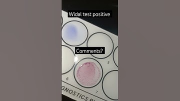 Serological practical WIDAL test positive#typhoidfever#trending #practical #pathology#shorts #status