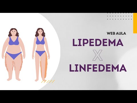 Entenda as diferenças entre lipedema e linfedema | Web Aula gratuita #120