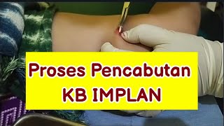 PROSES PENCABUTAN KB IMPLAN SUSUK II BIDAN ISNA