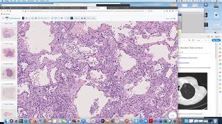 UW Pathology Resident Slide Seminar - Dr. Lynette Sholl (Harvard) - The Spectrum of Lung Neoplasia